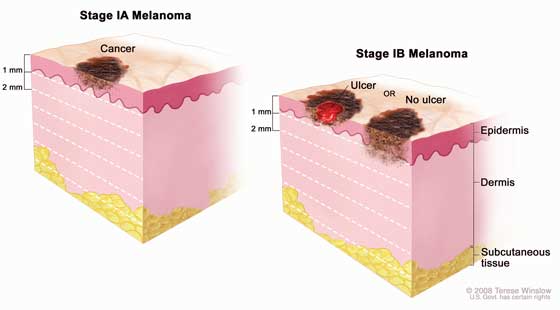 melanoma